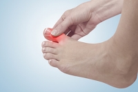 Managing Gout Attacks That Affect the Toes