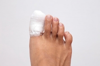 Severe or Mildly Broken Toes