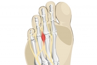 Prevention and Non-Surgical Solutions for Morton’s Neuroma