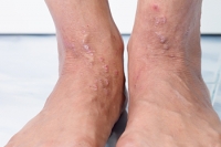 Buschke-Ollendorff Syndrome and the Feet