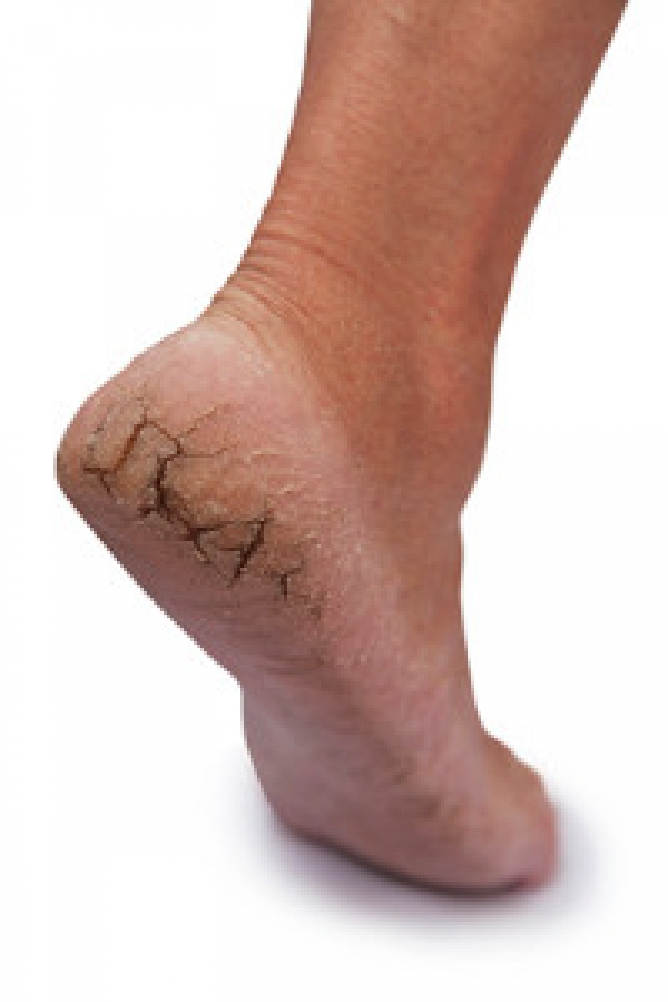 Men Are At Risk for Cracked Heels Too